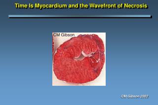 Time Is Myocardium and the Wavefront of Necrosis