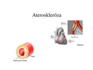 Ateroskleróza