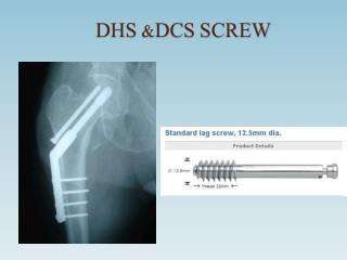 DHS &amp;DCS SCREW