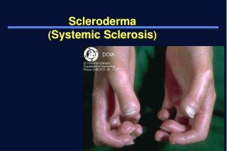 Scleroderma ( Systemic Sclerosis )
