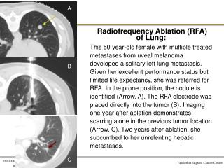 Radiofrequency Ablation (RFA) of Lung: