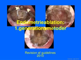 Endometrieablation: 1.generationsmetoder