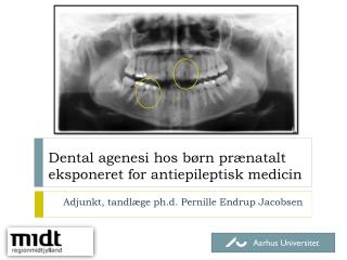 Dental agenesi hos børn prænatalt eksponeret for antiepileptisk medicin