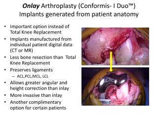 Onlay Arthroplasty ( Conformis - I Duo™) Implants generated from patient anatomy