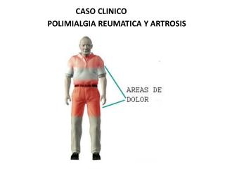 POLIMIALGIA REUMATICA Y ARTROSIS