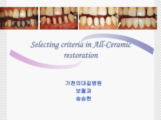 Selecting criteria in All-Ceramic restoration