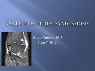 Ankle Fractures: syndesmosis