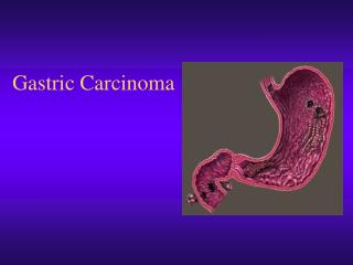 Gastric Carcinoma