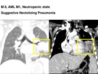 M 8, AML M1, Neutropenic state Suggestive Nectotizing Pneumonia