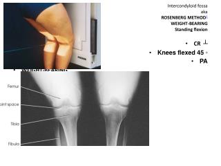 Intercondyloid fossa aka ROSENBERG METHOD 1 WEIGHT-BEARING Standing flexion