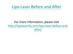 Lipo Laser Before and After