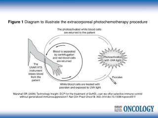 Figure 1 Diagram to illustrate the extracorporeal photochemotherapy procedure