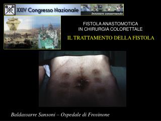 FISTOLA ANASTOMOTICA IN CHIRURGIA COLORETTALE