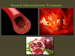 Natural Atherosclerosis Treatment
