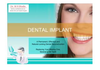 Dental Implants PPT | Dr. Bhalla Dental Clinic Ahmedabad