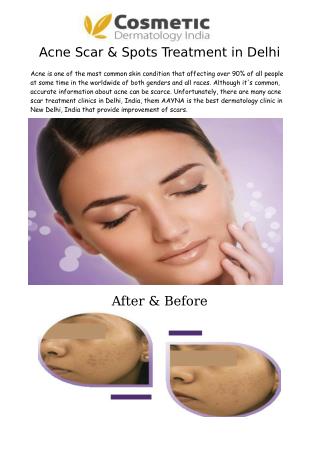 Acne Scar & Spots Treatment in Delhi - AAYNA