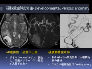 硬膜動静脈奇形 Developmental venous anomaly
