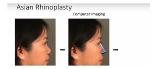 The best asian rhinoplasty surgeons in canada
