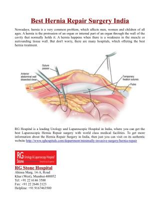 Best Hernia Repair Surgery India