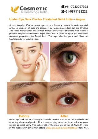 Under Eye Dark Circles Treatment Delhi, India– Aayna Clinics