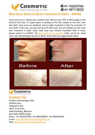 Best Acne Scars Treatment Delhi India – Aayna Clinic