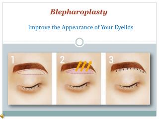 What is Eyelid Surgery Blepharoplasty