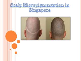 scalp micropigmentation Singapore