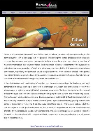 Tattoo Removal