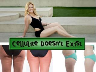 Cellulite Doesn’t Exist