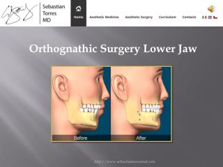 Orthognathic Surgery Lower Jaw