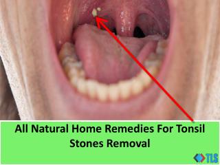 All Natural Home Remedies For Tonsil Stones Removal