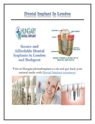 Dental Implant In London