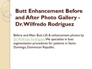 Butt Enhancement Before and After Photo Gallery - Dr. Wilfredo Rodríguez