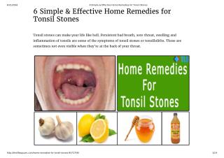 6 Home Remedies for Tonsil Stones