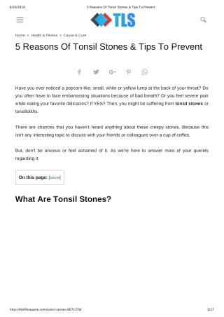 5 Reasons Of Tonsil Stones & Tips To Prevent