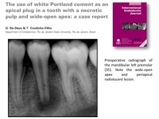 Preoperative radiograph of the mandibular left premolar (35). Note the wide-open apex and periapical radiolucent lesion