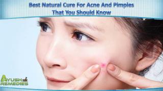 Best Natural Cure For Acne And Pimples That You Should Know
