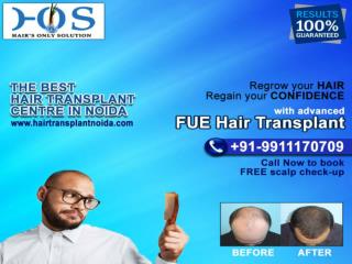 Best Hair Transplant in Delhi