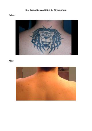 Best tattoo removal Cilinic In Birmingham