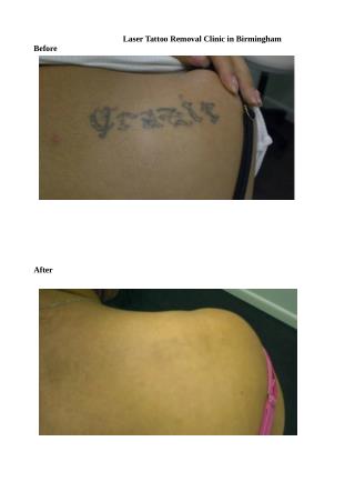 Laser Tattoo Removal Clinic in Birmingham