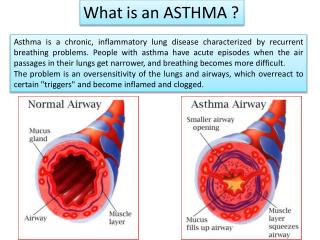 homeopathy treatment for asthma