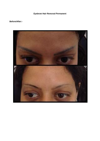 Permanent Eyebrow Removal Birmingham UK-Unwanted Tattoos