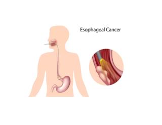 Barrett's Esophagus, Barrett's Esophagus Metaplasia, Barrett's Esophagus Bulimia