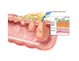 Barretts Esophagus, Barrett's Esophagus Hiatal Hernia, Barrett's Esophagus Epithelium