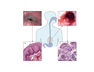 Barrett's Esophagus Treatment, Barrett's Esophagus Ablation, Barrett's Esophagus And Smoking