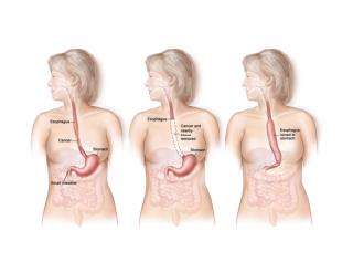 Barrett's Esophagus Symptoms, Barrett's Esophagus Disease, Barrett's Esophagus And Hiatal Hernia