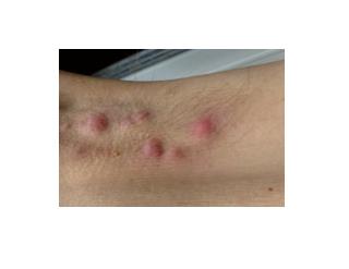 Hidradenitis Suppurativa Surgery, Hidradenitis Suppurativa Photos, Hidradenitis Suppurativa Nz