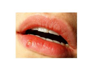 Corner Of Mouth Cracked, Angular Cheilitis, Home Remedies For Angular Cheilitis, Angular Cheilitis