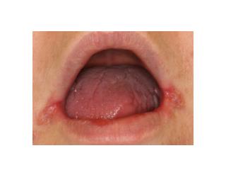 Cracked Corners Of Mouth, Cheilitis, Angular Cheilitis Remedy, Angular Cheilitis Medicine, Cheilitis