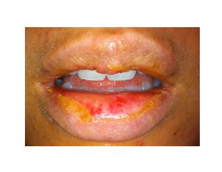 Cracked Lip Corners, Angular Cheilitis Treatment, Angular Cheilitis Home Remedies, Angular Cheilitis
